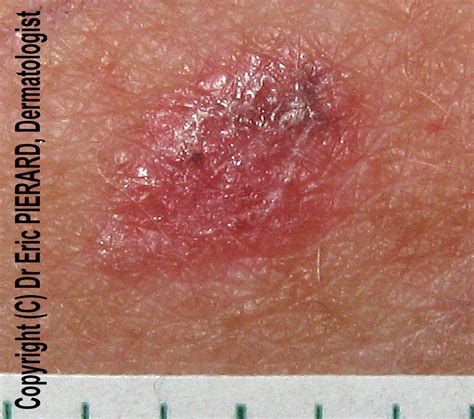 Skin Cancer Lesions On Arms