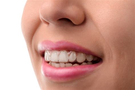 Can Invisalign Clear Braces be Used to Fix TMJ Disorder?