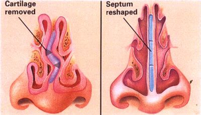 Septoplasty and Turbinate Reduction - Rhinoplasty Clinic Sydney | Nasal ...