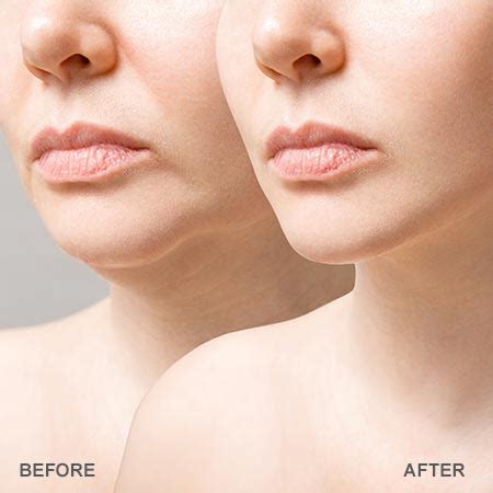 Botox For Jowls: Treatment, and Before and After