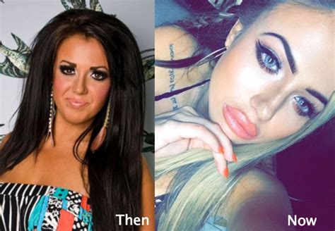 Holly Hagan Plastic Surgery Before and After Photos