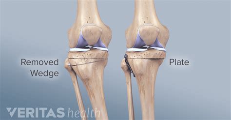 High Tibial Osteotomy Surgery – Importance, Risk and Cost - Sutured