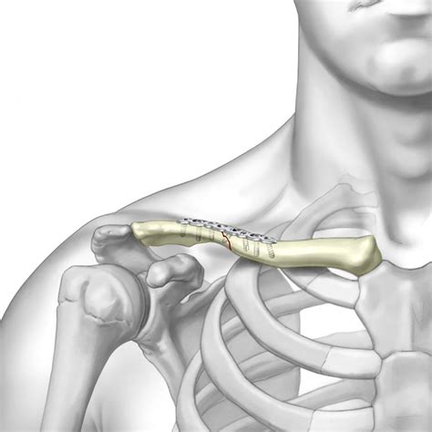 TriMed Clavicle Plate System - CliniLab