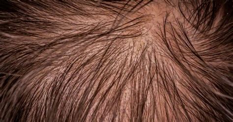 3 Alopecia Areata Regrowth Signs: According To Alopecian