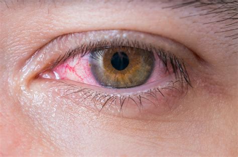 Eye Irritation: When to See a Doctor - Magruder Eye Institute