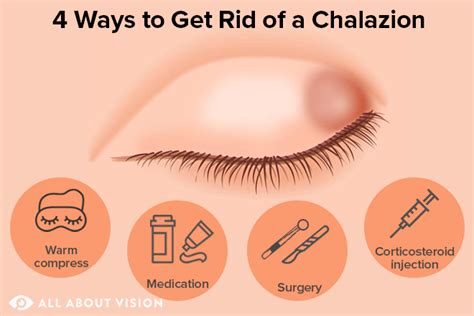 What Is a Chalazion (Bump on Eyelid)?