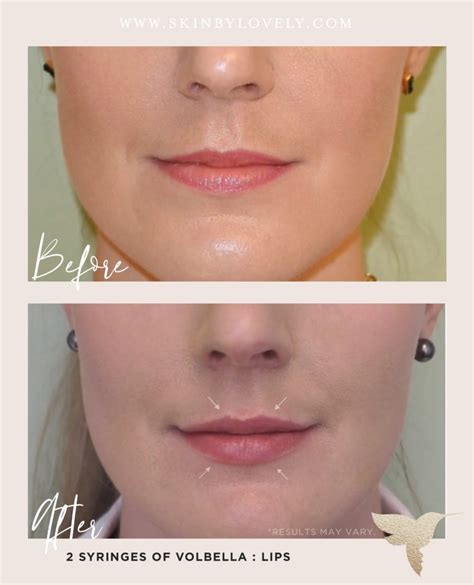 Lip Filler vs. Lip Lift vs. Lip Flip - Skin by Lovely