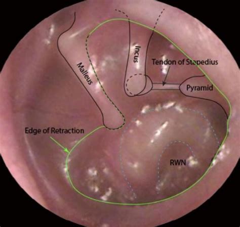 Retracted Eardrum Eustachian Tube Dysfunction