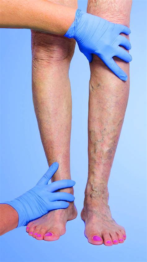 Vanquish your varicose veins - Harvard Health