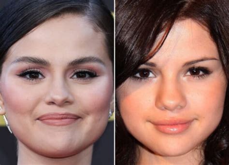 Selena Gomez Plastic Surgery: Has The Singer Undergone A Plastic Surgery?