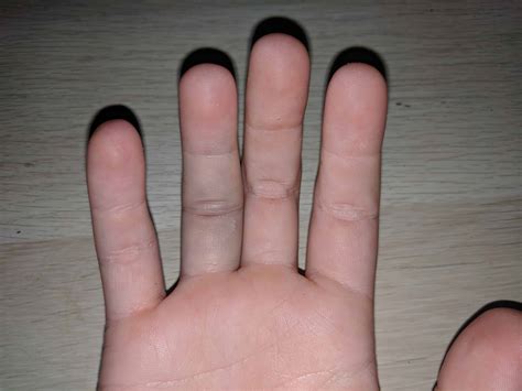 How to Treat a Sprained Finger - Physioroom Blog