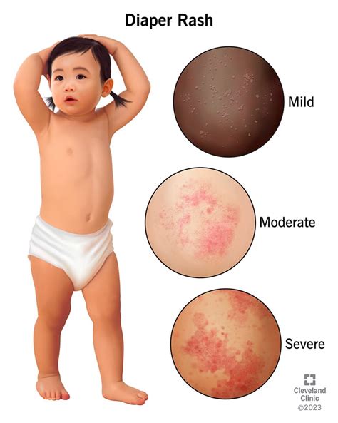 Diaper Rash: Symptoms, Causes & Treatment