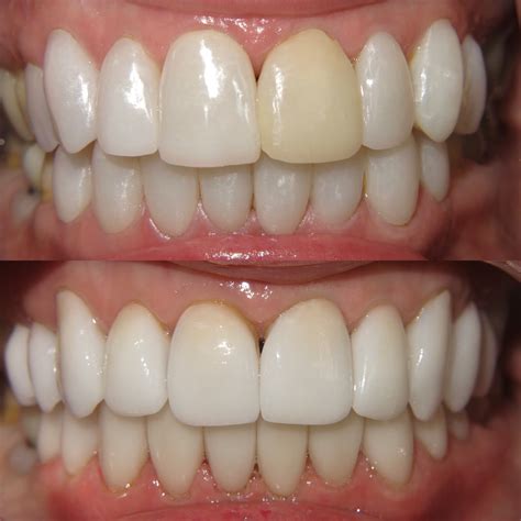 How Well Does LED Teeth Whitening Work?