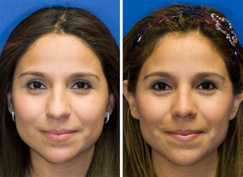 Bulbous Nose Rhinoplasty Before And After