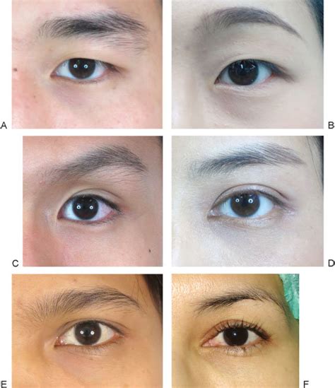 Asian eyelid morphologies are categorized into six types. (A) Single ...