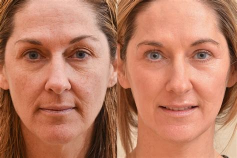 Laser Resurfacing - An Infinitely Customizable Way to Improve your Skin ...