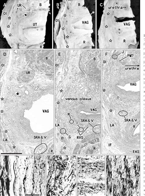 Pubocervical ligament | Semantic Scholar