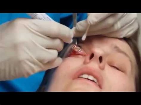 Eye cyst removal - YouTube