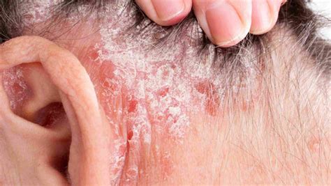 Psoriasis In The Ear: Symptoms, Treatment, and Prevention – Dermeleve®