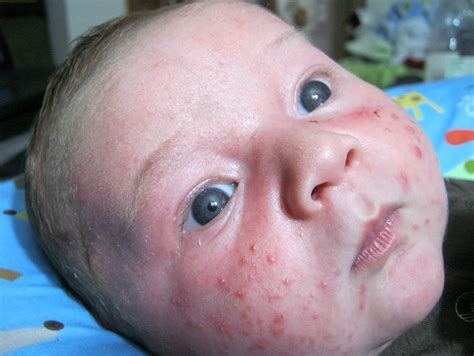 Baby Acne Symptoms, Causes, Diagnosis and Treatment - Natural Health News