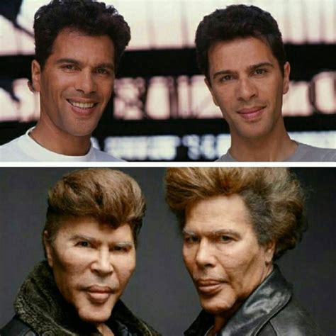 bogdanoff brothers plastic surgery