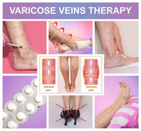 Treatment of Varicose Veins Stock Photo - Image of health, pressure ...