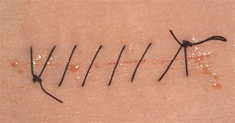 Simple Running Suture Technique. How to master it. | UpSurgeOn