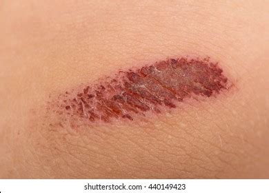 8,467 Abrasion Skin Images, Stock Photos & Vectors | Shutterstock