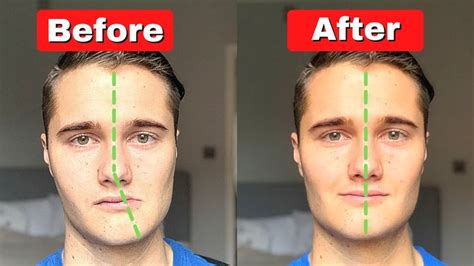 How to Fix Asymmetrical Jaw & Face (TODAY!) - YouTube in 2024 | Facial ...