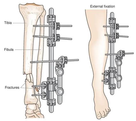 External Fixation Devices – MED Institute