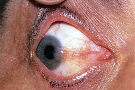 Pterygium eye disease - Stock Image - M155/0058 - Science Photo Library