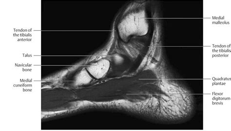 Foot Muscles Mri : Ankle Mri Anatomy Youtube : .magnetic resonance ...