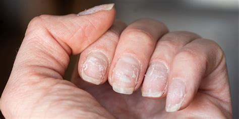 Here’s Why Your Nails Keep Peeling and Flaking—and What to Do About It