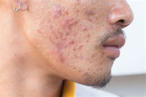 Risk of Bacterial Resistance in Systemic Antibiotic Use for Acne