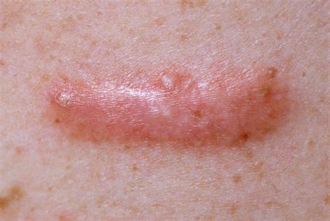 Practice dilemma: Refusing a request for keloid scar removal | GPonline