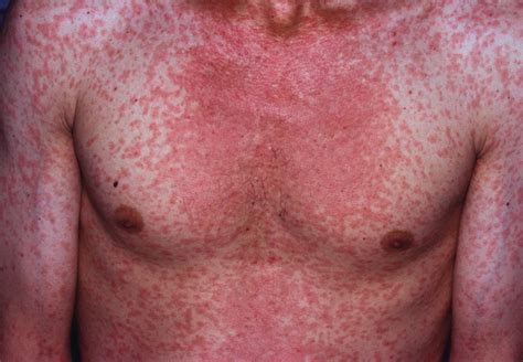 Early Symptoms Of Measles