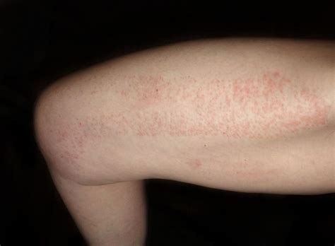 Red Spots on Skin: Causes, Diagnosis, and Treatments