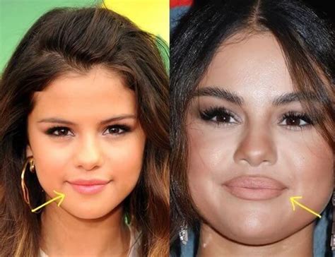 Selena Gomez Plastic Surgery: Rumors, Before & After Photos ...