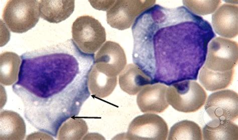 Infectious Mononucleosis Blood Smear