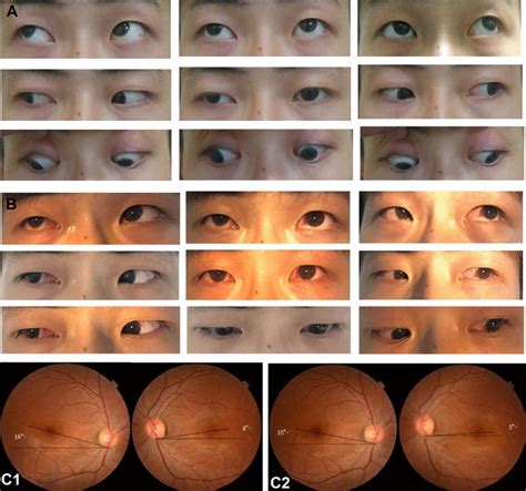 A patient of group (B). a Preoperative eye position images; the patient ...