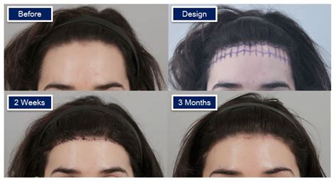 Recovery Process for forehead reduction surgery - IDHOSPITAL