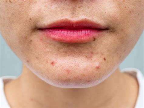 adapalene making acne worse - Lillian Hart