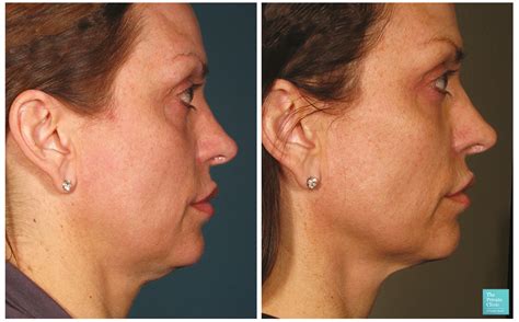 Sagging Jowls treatment | Liposuction for sagging jowls and double chin