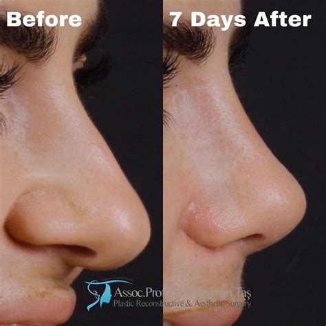 permanent non surgical nose job near me - Machelle Peak