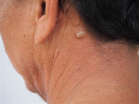 What are the treatments for sebaceous cyst?