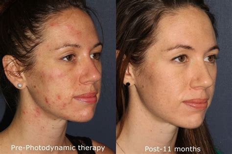 Photodynamic Therapy Acne Treatment | San Diego, CA | CLDerm