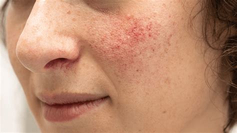 Erythematotelangiectatic Rosacea: Causes, Remedies | Gladskin