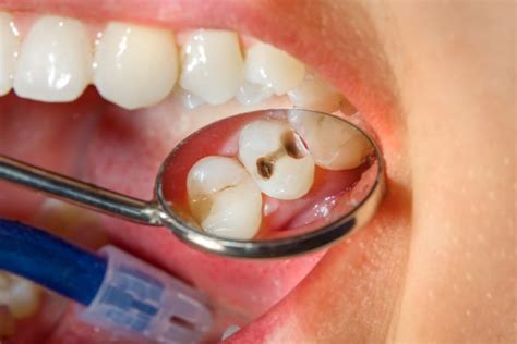 Cavity Treatment: How to Treat the 3 Most Common Types of Cavities ...