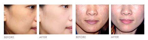 SKIN WHITENING Before After - Premier Clinic (CN)