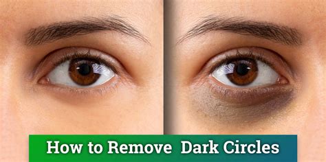 Effective Natural Remedies To Get Rid Of Dark Eye Circle In Indiana ...